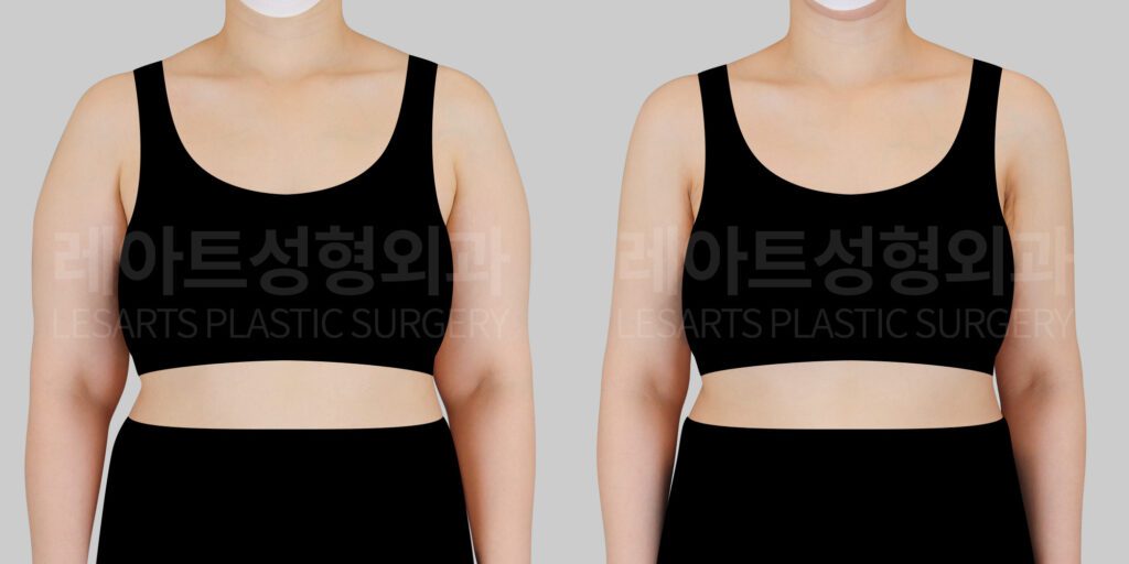 arm liposuction before and after