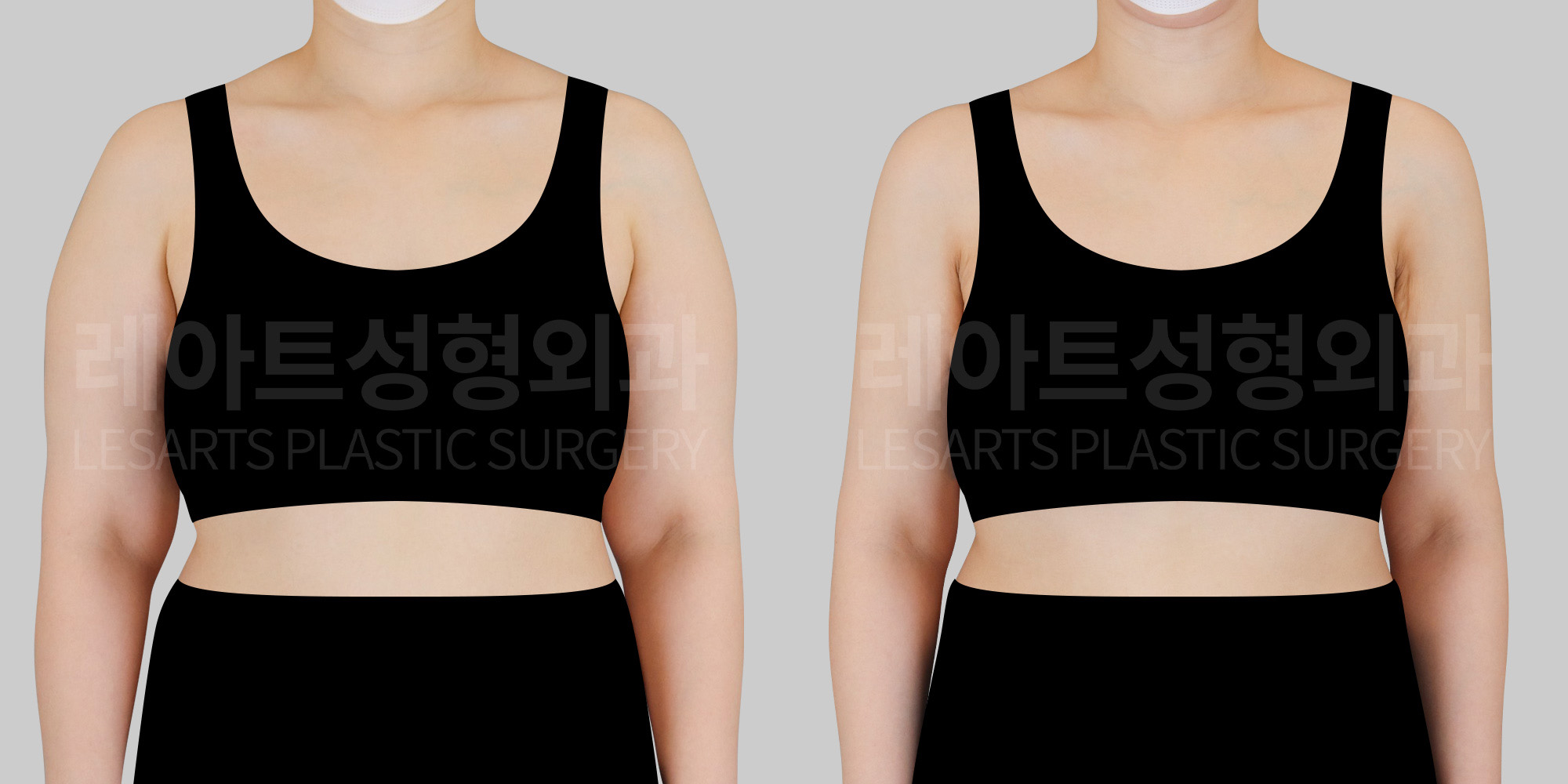 arm liposuction before and after