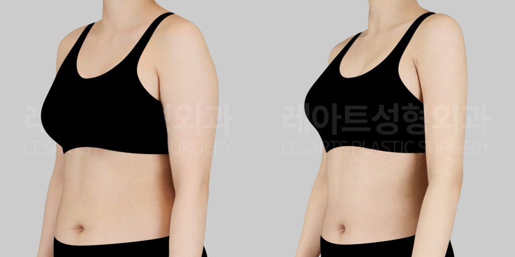 lesarts arm liposuction-before and after