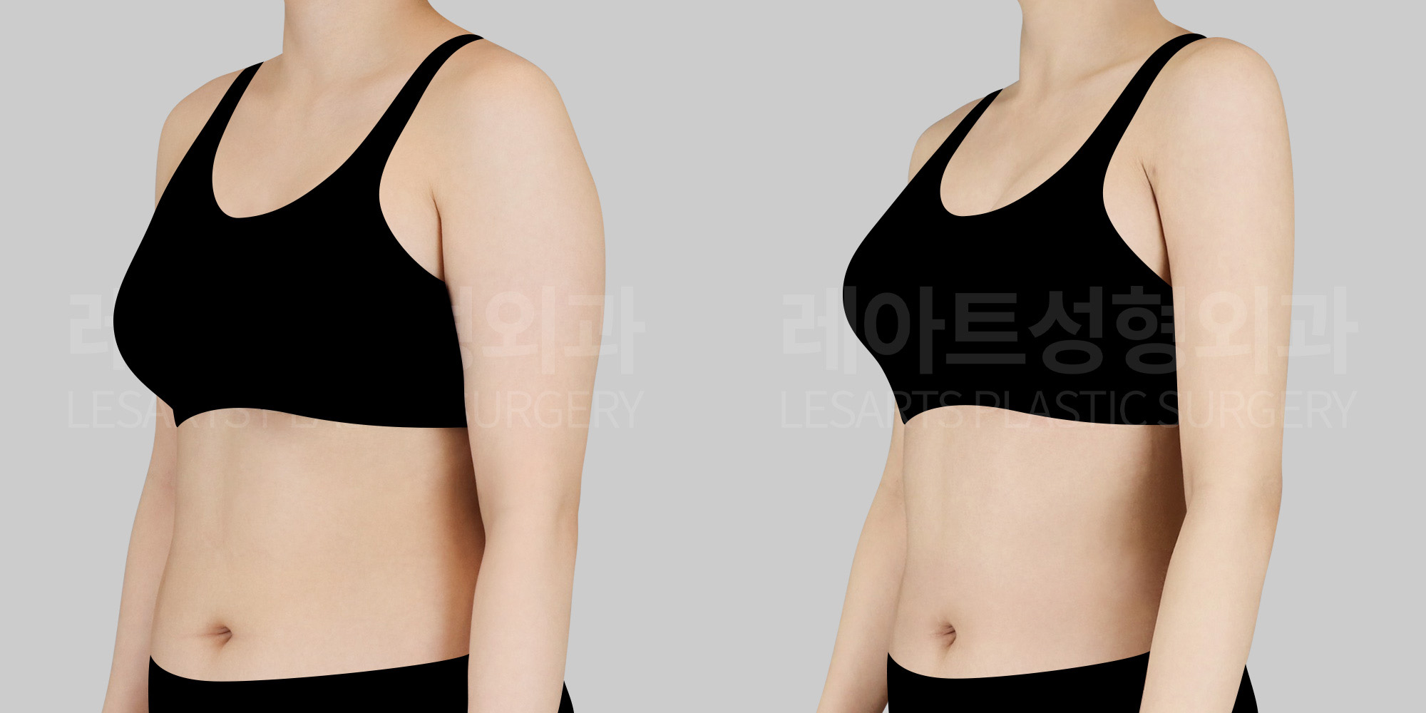 lesarts arm liposuction-before and after