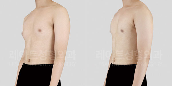 lesarts gynecomastia before and after