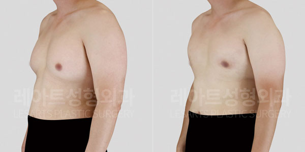 lesarts gynecomastia before and after