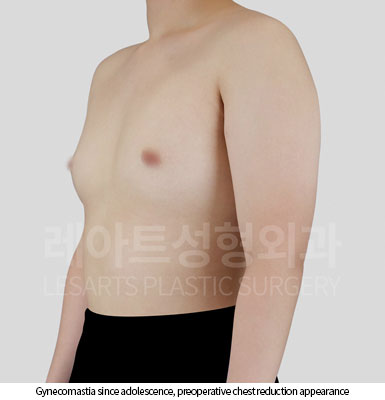 gynecomastia-02-01-251119