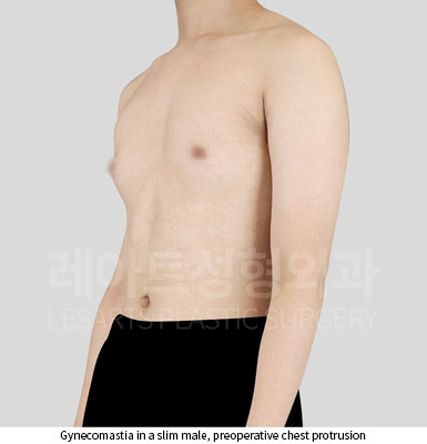 gynecomastia-02-01-251121