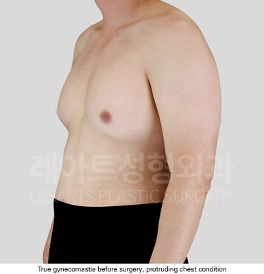 gynecomastia-02-01-251125