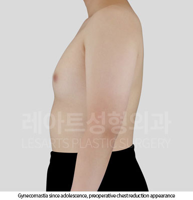 gynecomastia-02-02-251119