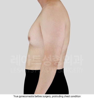 gynecomastia-02-02-251125