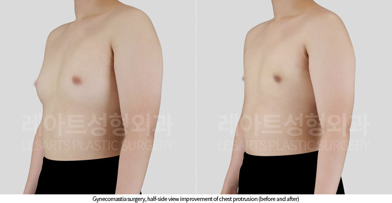 gynecomastia-02-03-251119