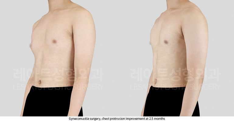gynecomastia-02-03-251121