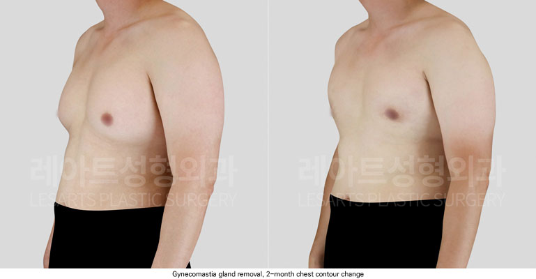 gynecomastia-02-03-251125