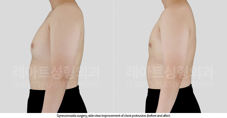 gynecomastia-02-04-251119