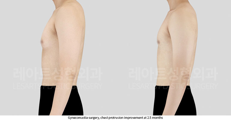 gynecomastia-02-04-251121