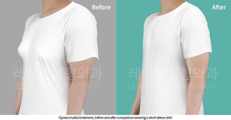 gynecomastia-02-05-251119