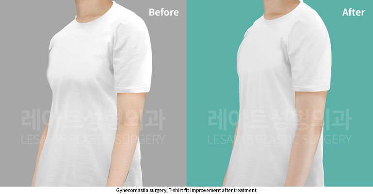 gynecomastia-02-05-251121