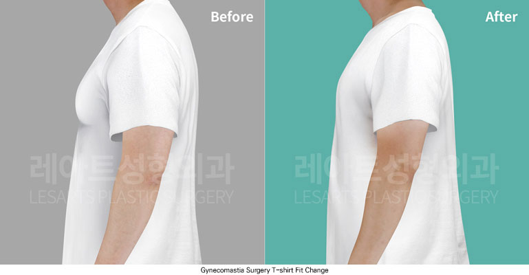 gynecomastia-02-05-251125