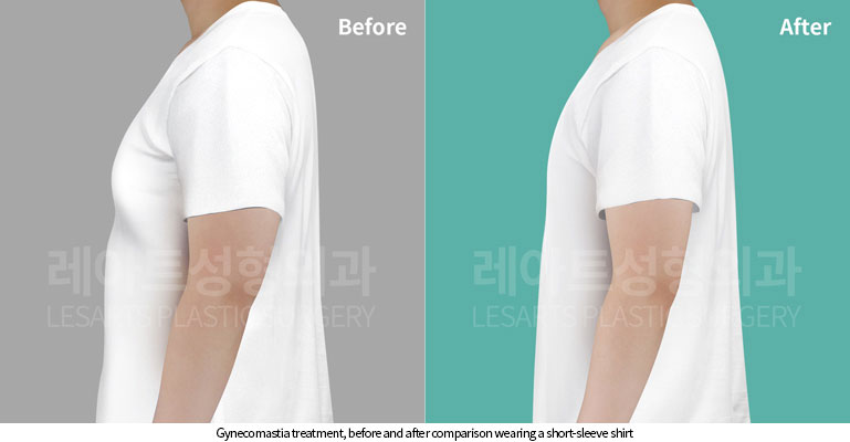 gynecomastia-02-06-251119