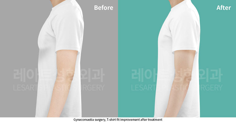 gynecomastia-02-06-251121