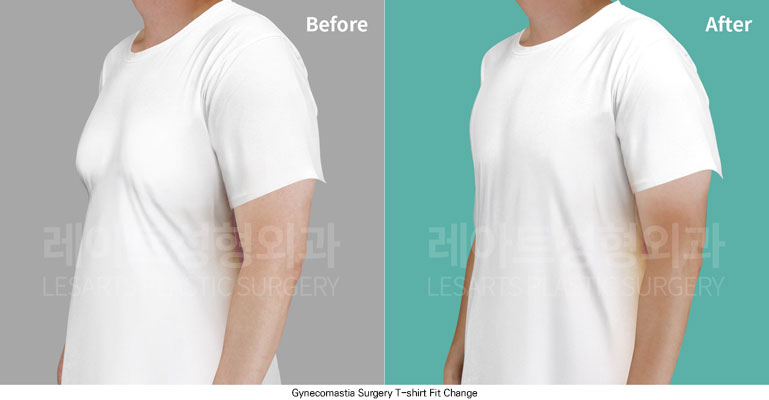 gynecomastia-02-06-251125