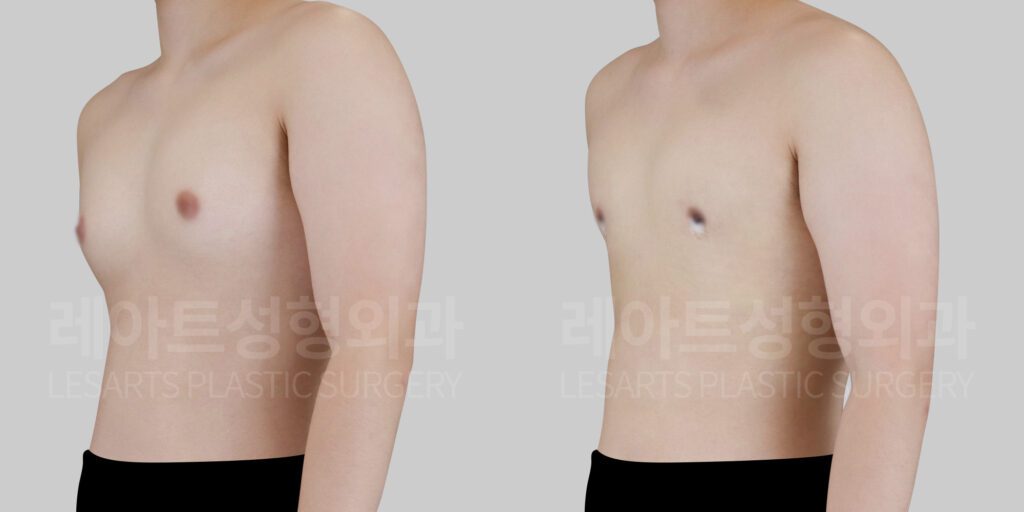 gynecomastia before and after