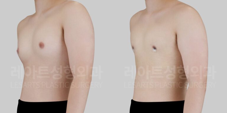 gynecomastia before and after