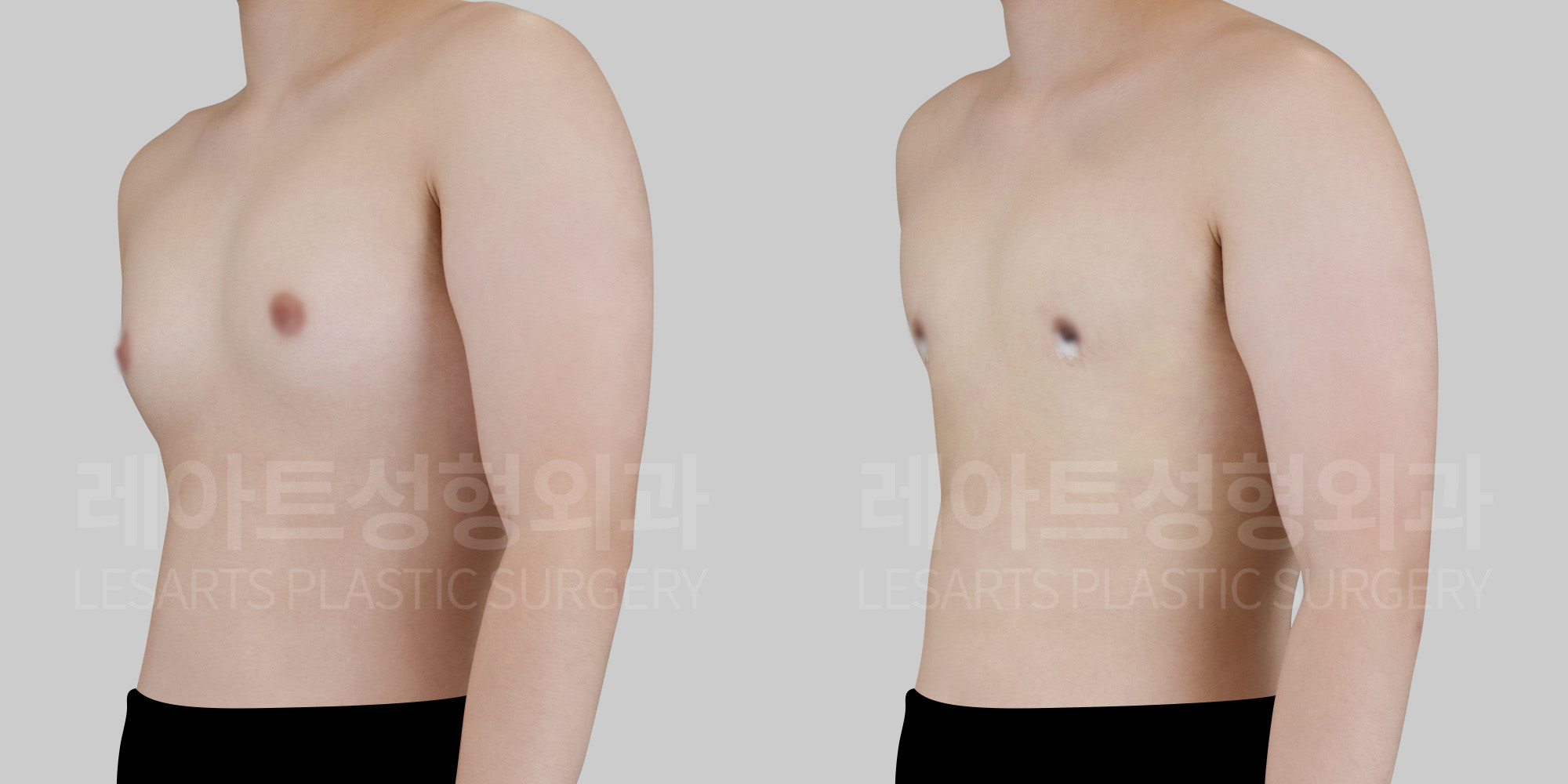 gynecomastia before and after