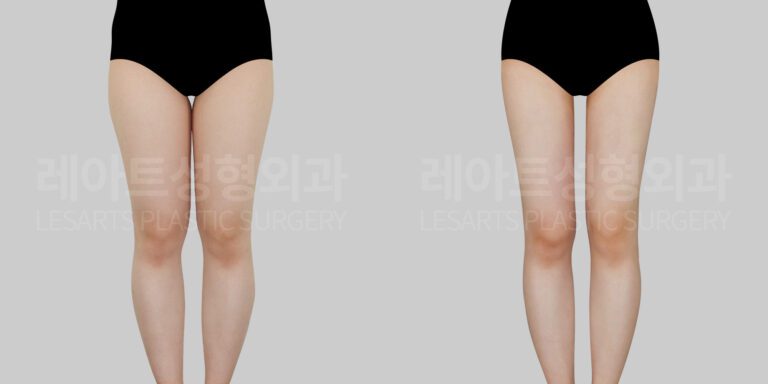 thigh liposuction before and after