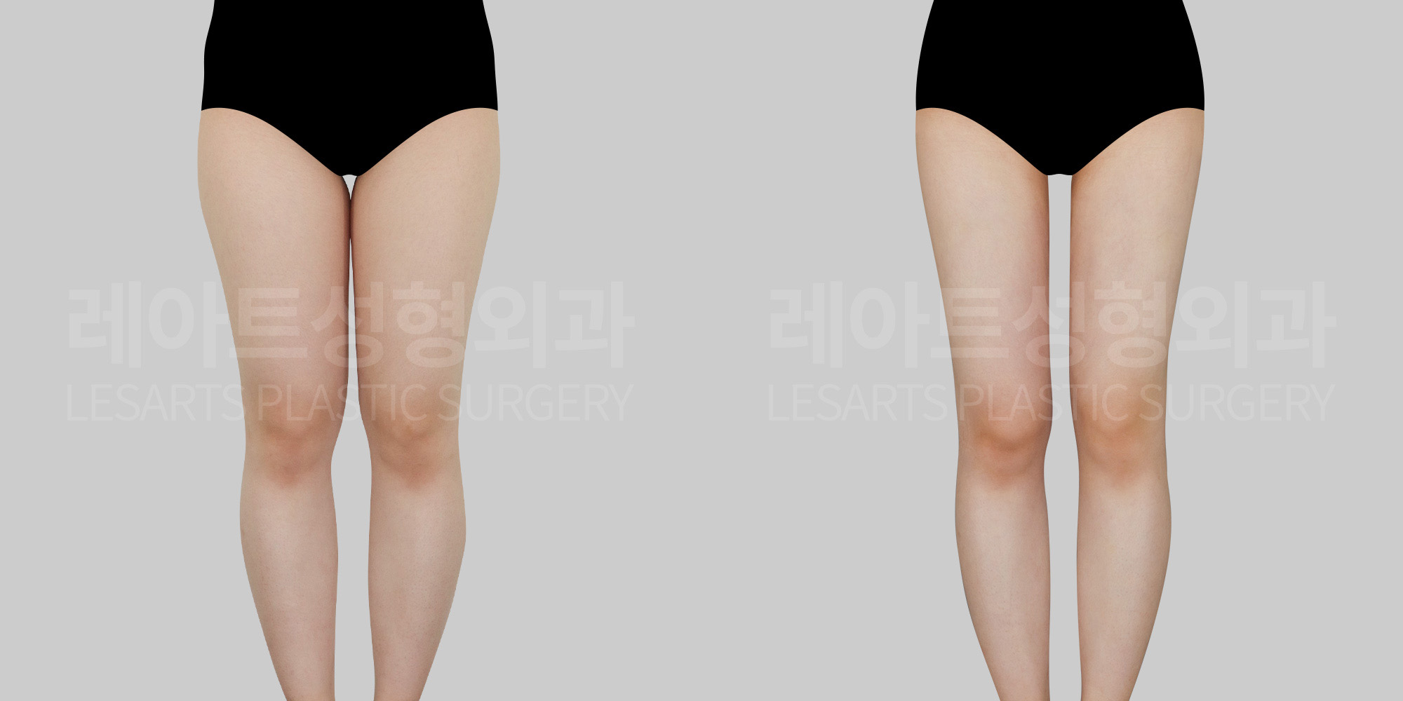 thigh liposuction before and after