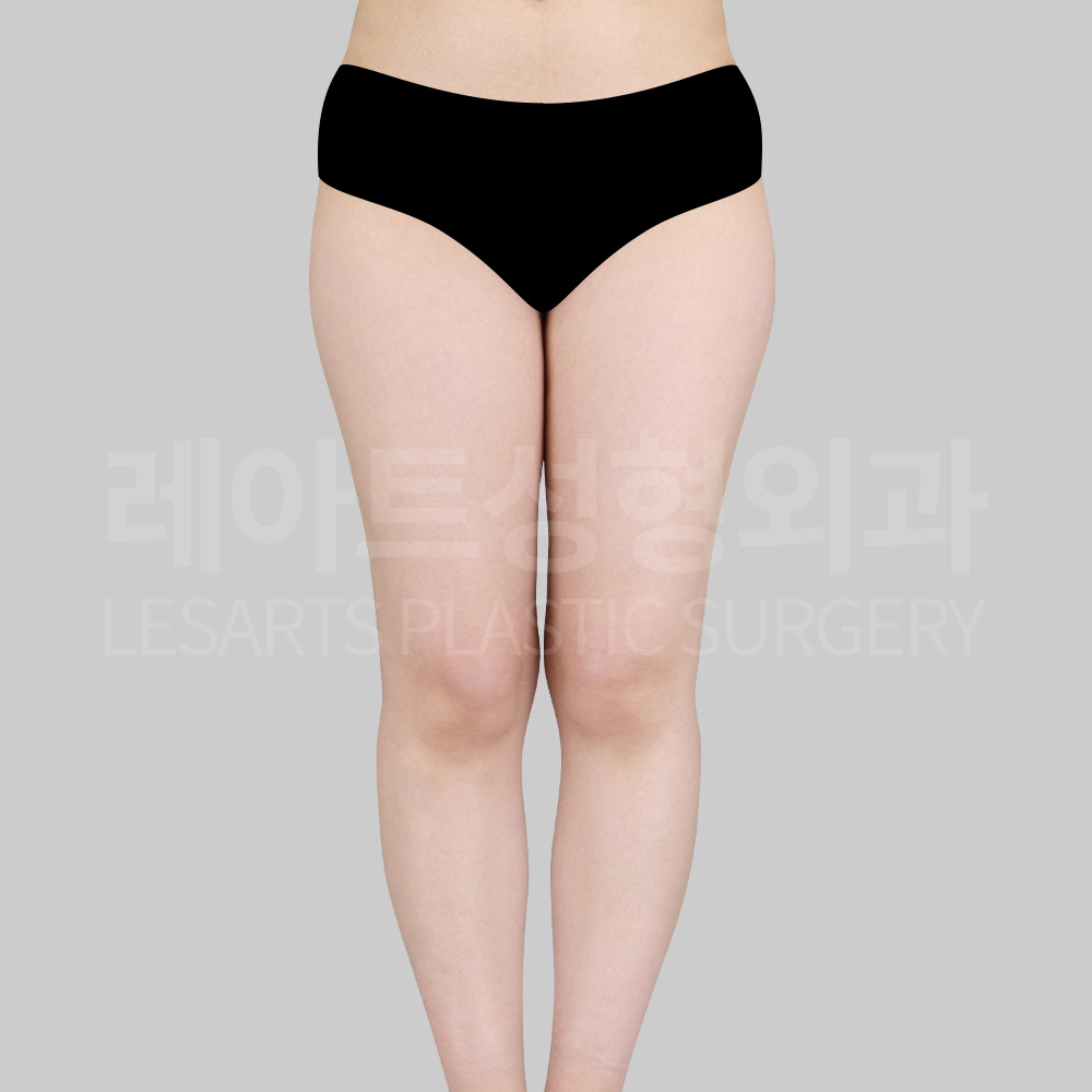 thigh-liposuction-23198-before-front