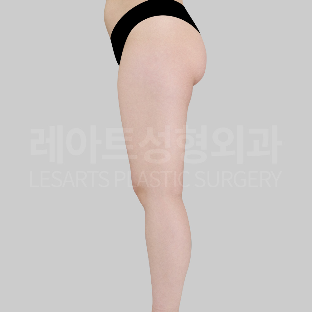 thigh-liposuction-23198-before-side