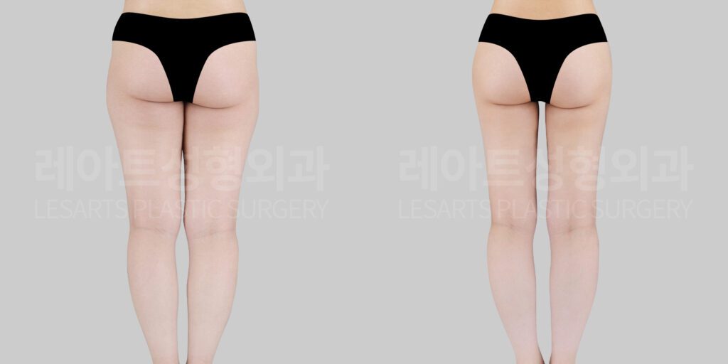 thigh liposuction and hip dip fat transfer before and after