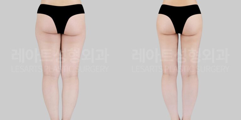 thigh liposuction and hip dip fat transfer before and after