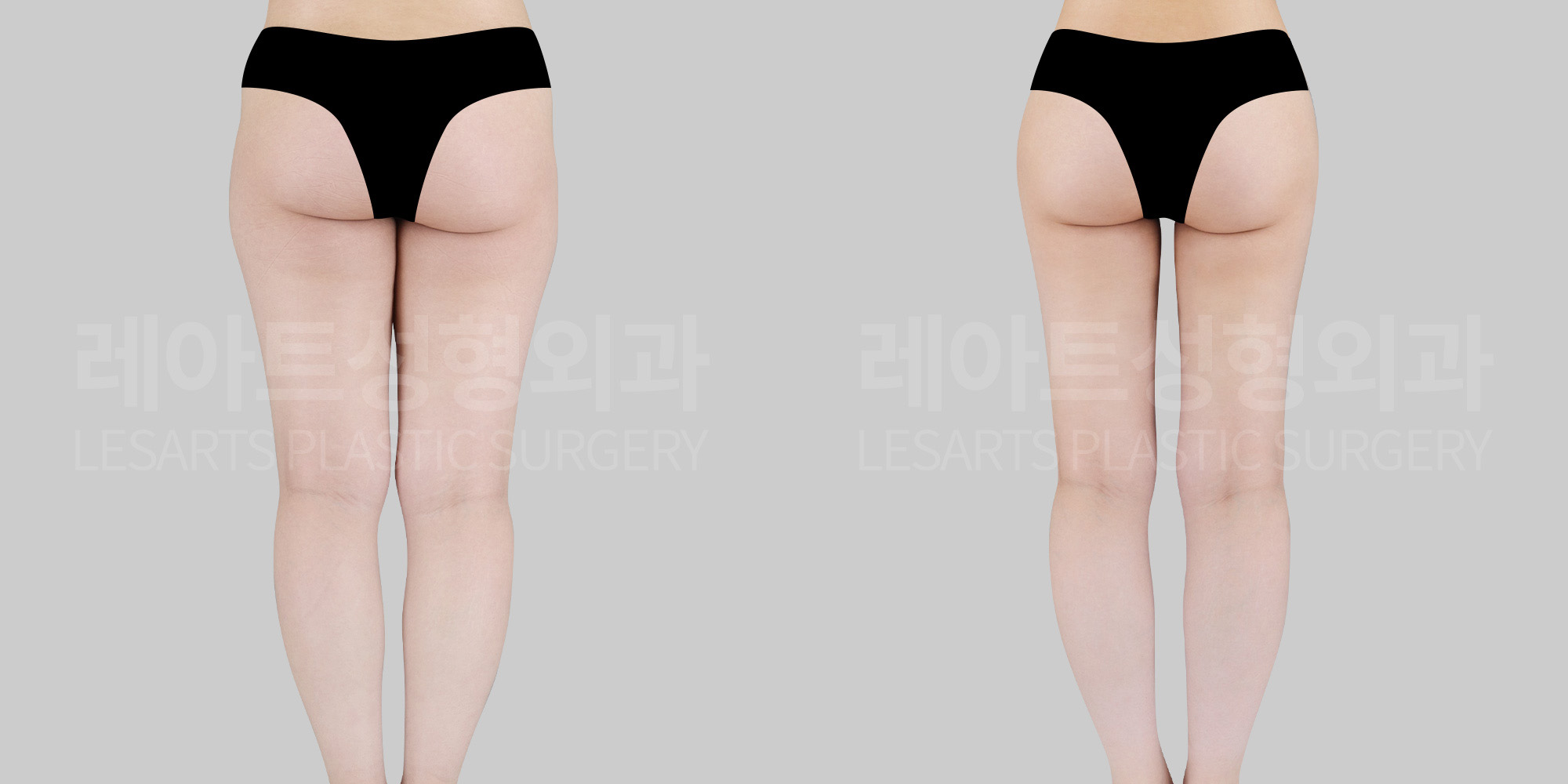 thigh liposuction and hip dip fat transfer before and after