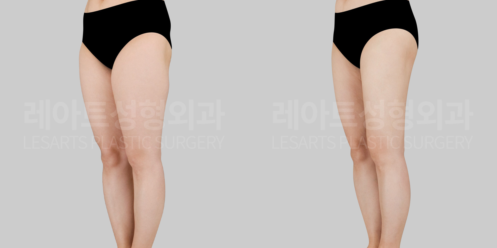 Thigh Liposuction – The Moment Your Confidence Changes in Front of the Mirror, We Design Your Hidden Lines