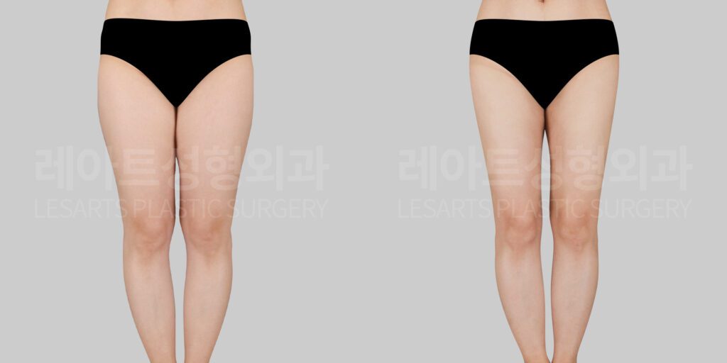 thigh liposuction before and after