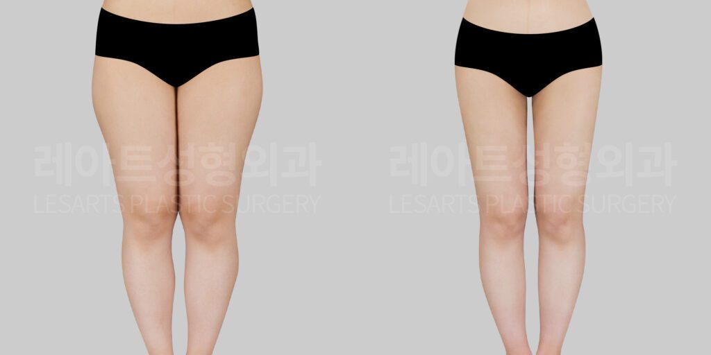 lesarts thigh liposuction before and after