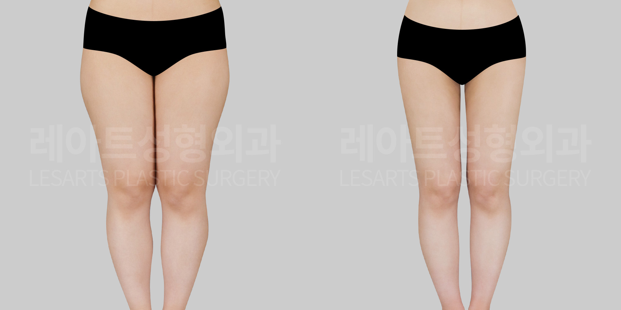 lesarts thigh liposuction before and after