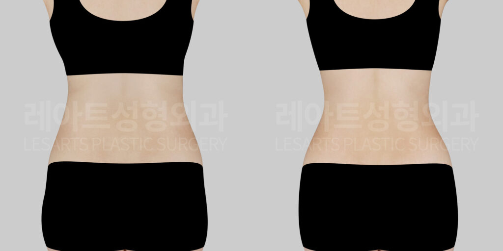 abdominal liposuction before and after
