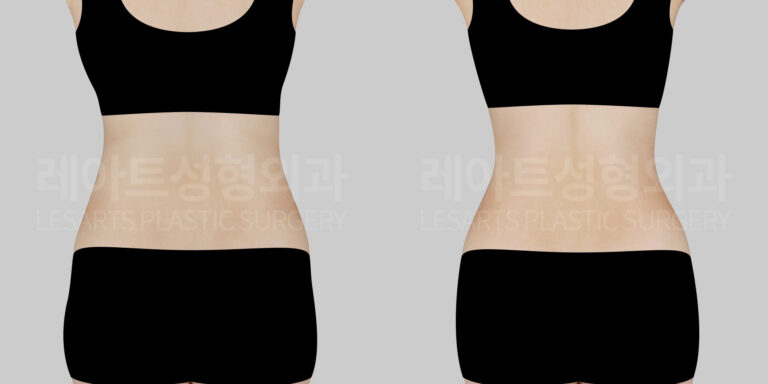 abdominal liposuction before and after