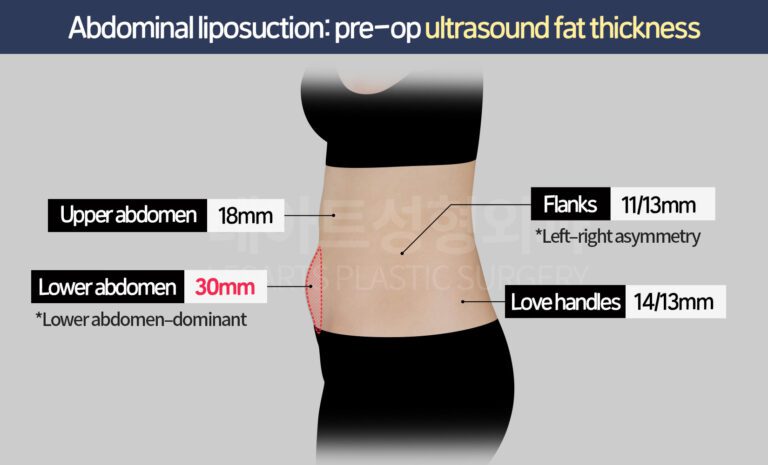abdominal-liposuction-30913-before-fat-thickness