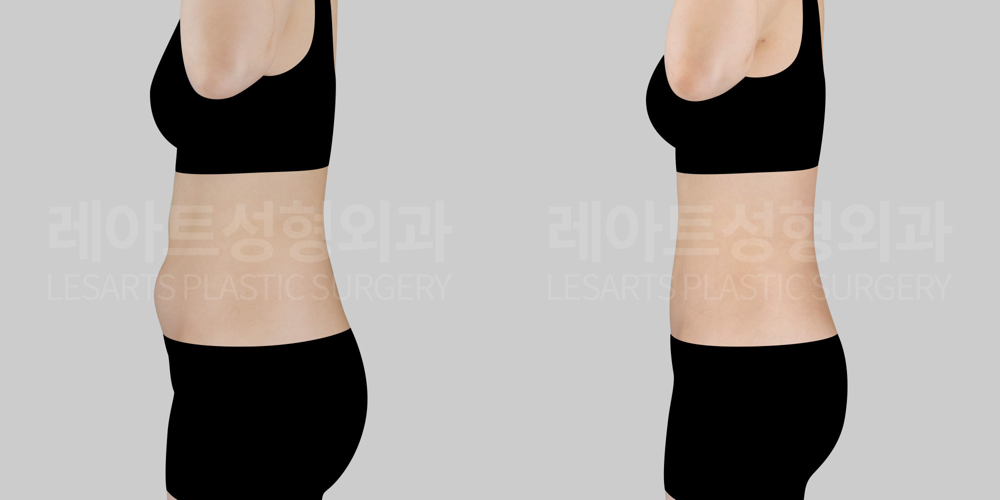 abdominal liposuction before and after-lesarts plastic surgery
