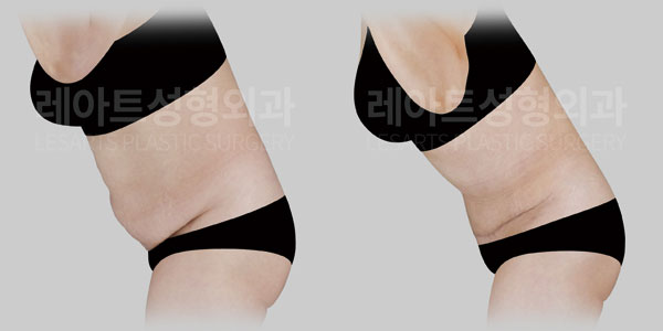 abdominoplasty before and after