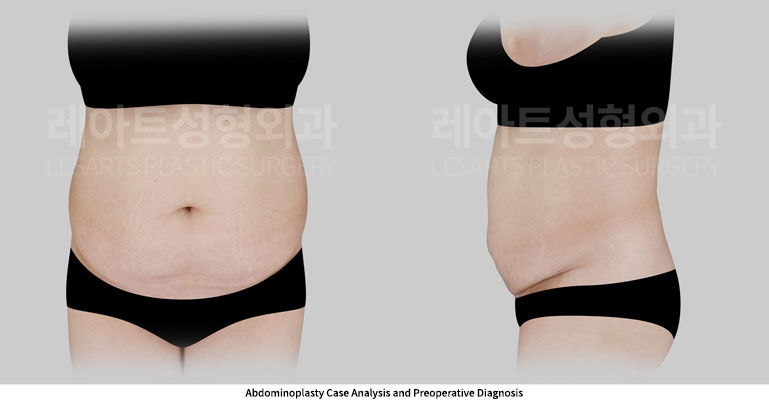 abdominoplasty-02-01-251127