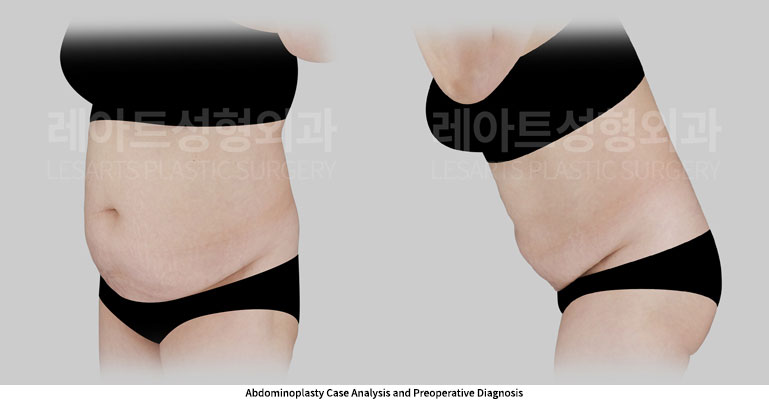 abdominoplasty-02-02-251127