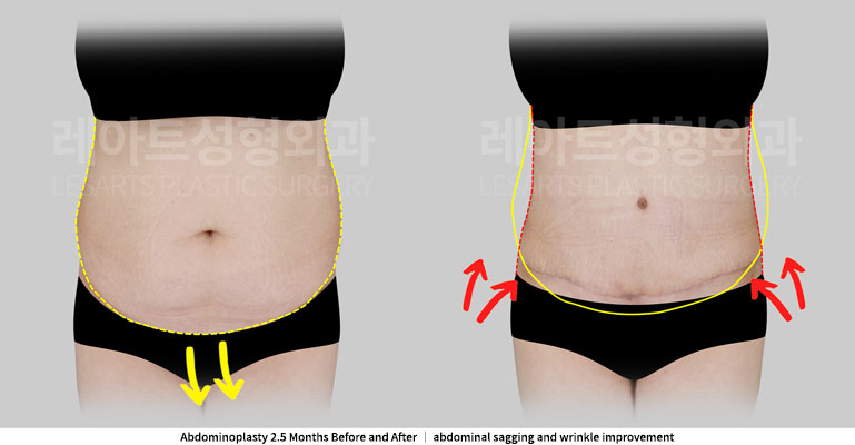 abdominoplasty-02-03-251127