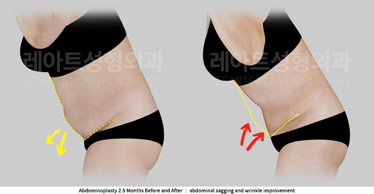 abdominoplasty-02-04-251127