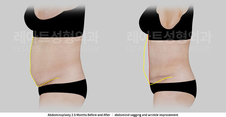 abdominoplasty-02-05-251127