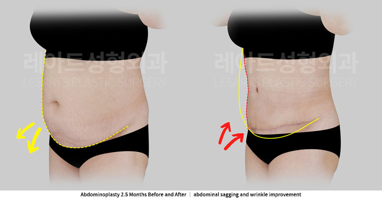 abdominoplasty-02-06-251127