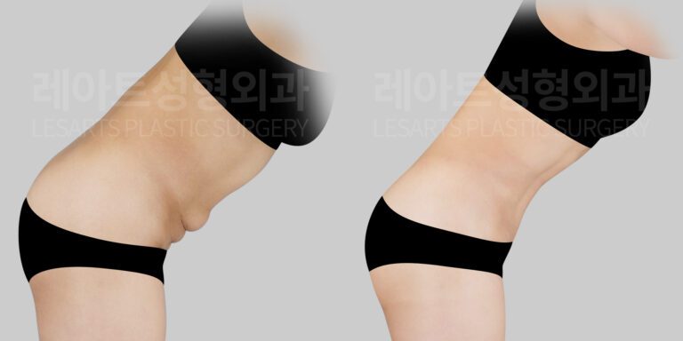 abdominoplasty before and after-lesarts plastic surgery