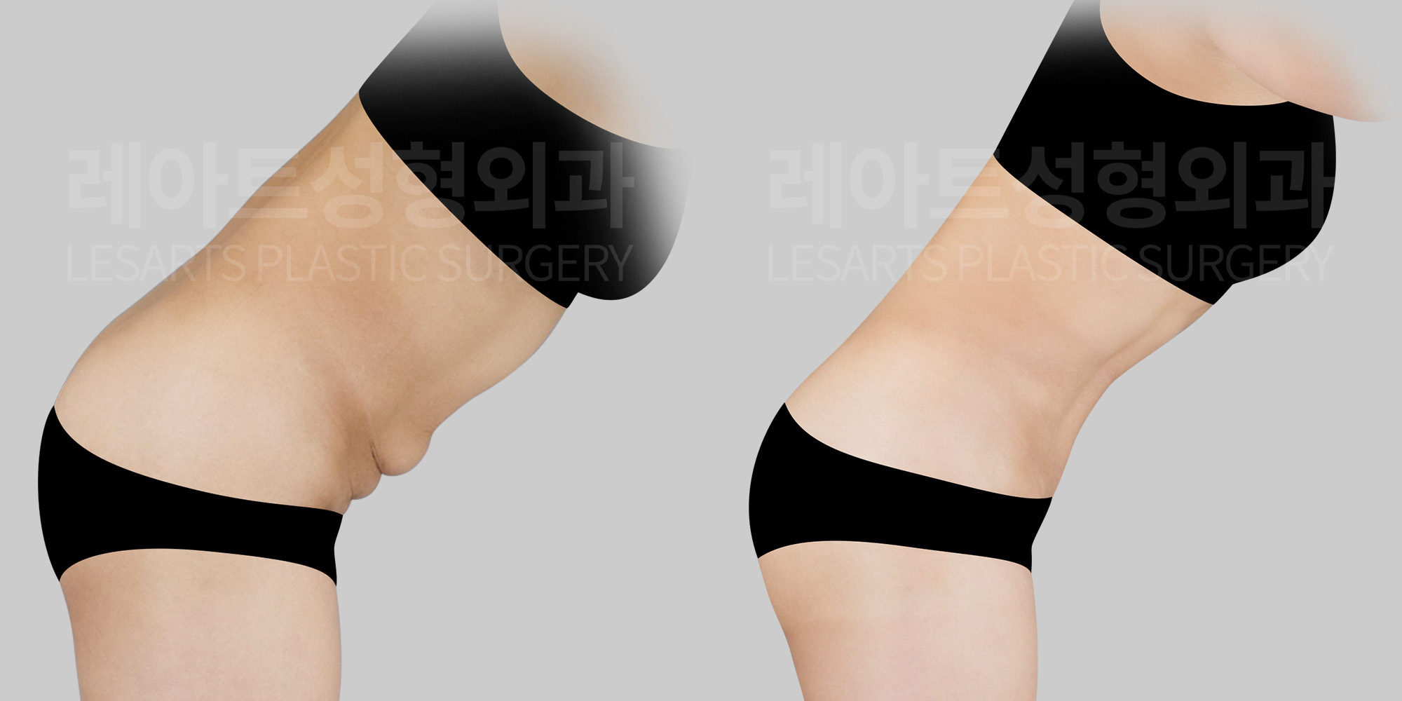 abdominoplasty before and after-lesarts plastic surgery