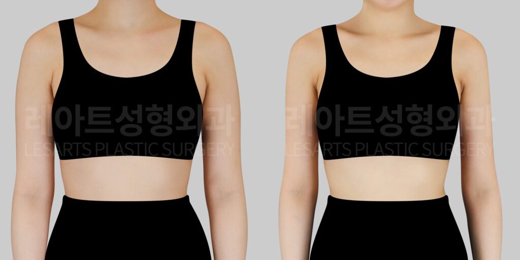 arm liposuction before and after(front)-lesarts plastic surgery